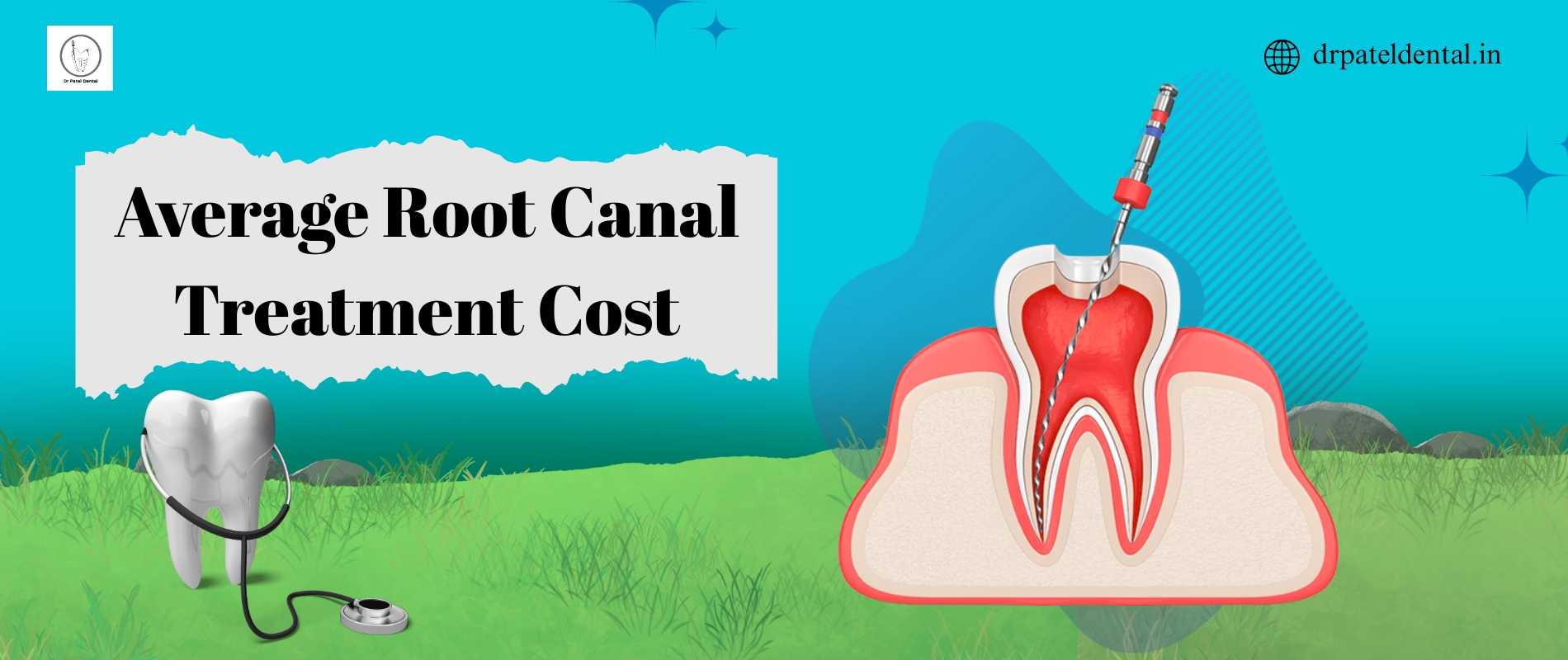 Root Canal Treatment Cost in Bangalore